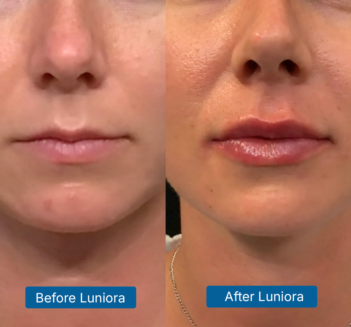 8D Hyaluronic Acid + PDRN Plump Serum